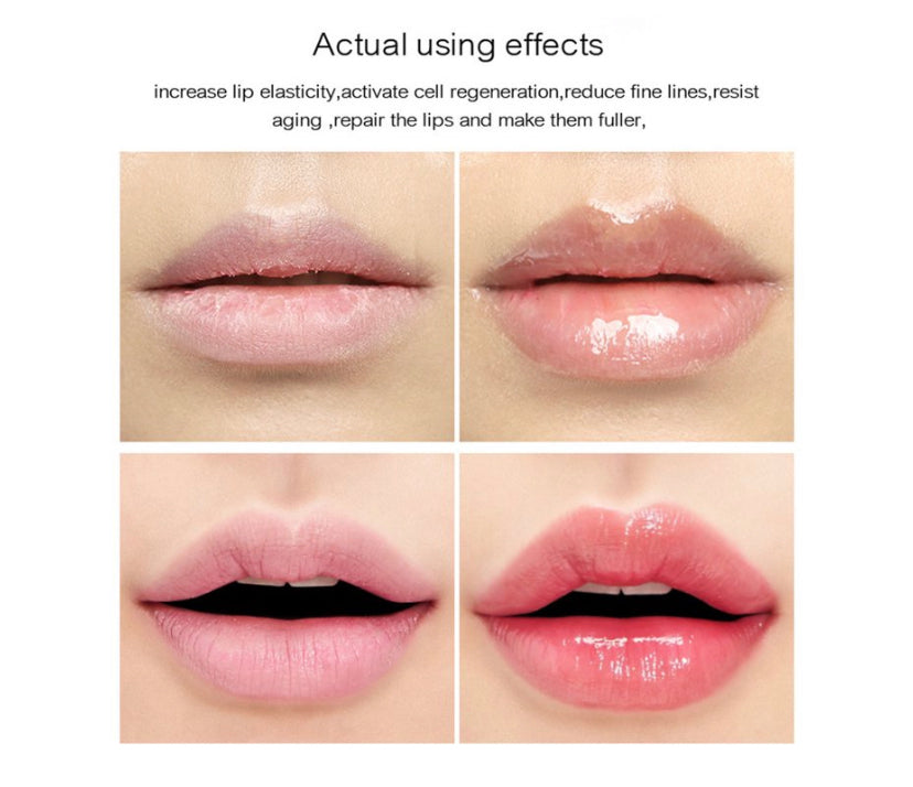 LIP PLUMP KARITÉ INJECTION
